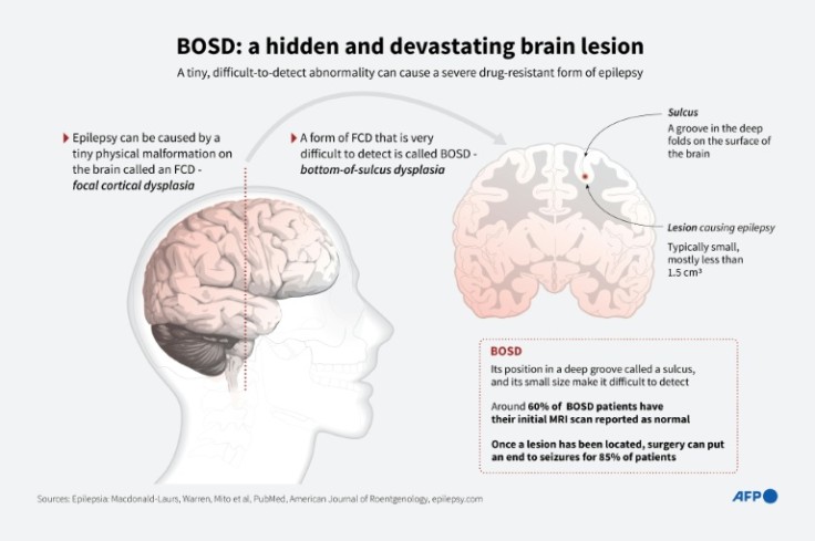 Infographic explainer of BOSD, a difficult-to-detect form of an epilepsy-causing brain malformation